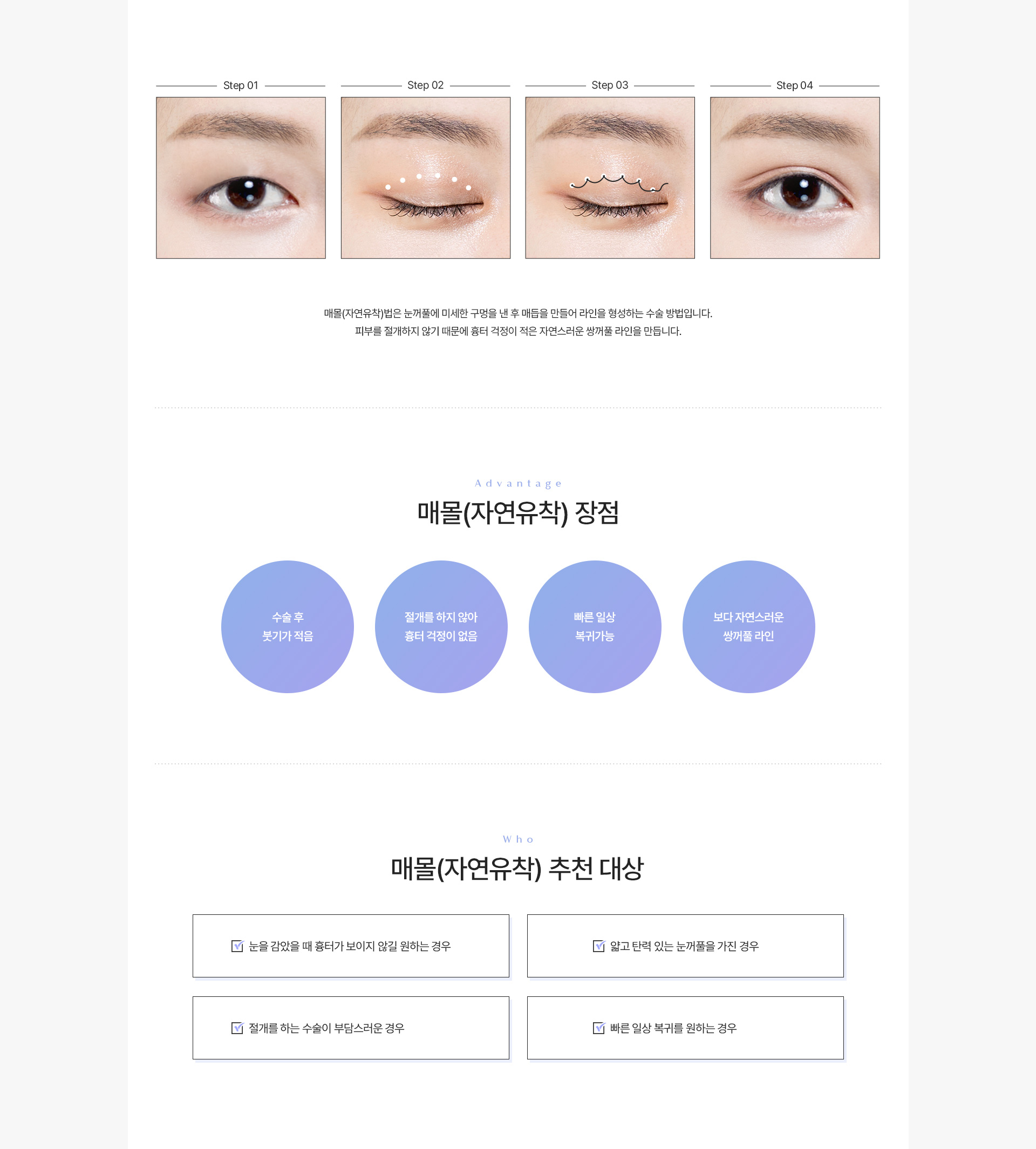 쌍커풀 매몰법 내용