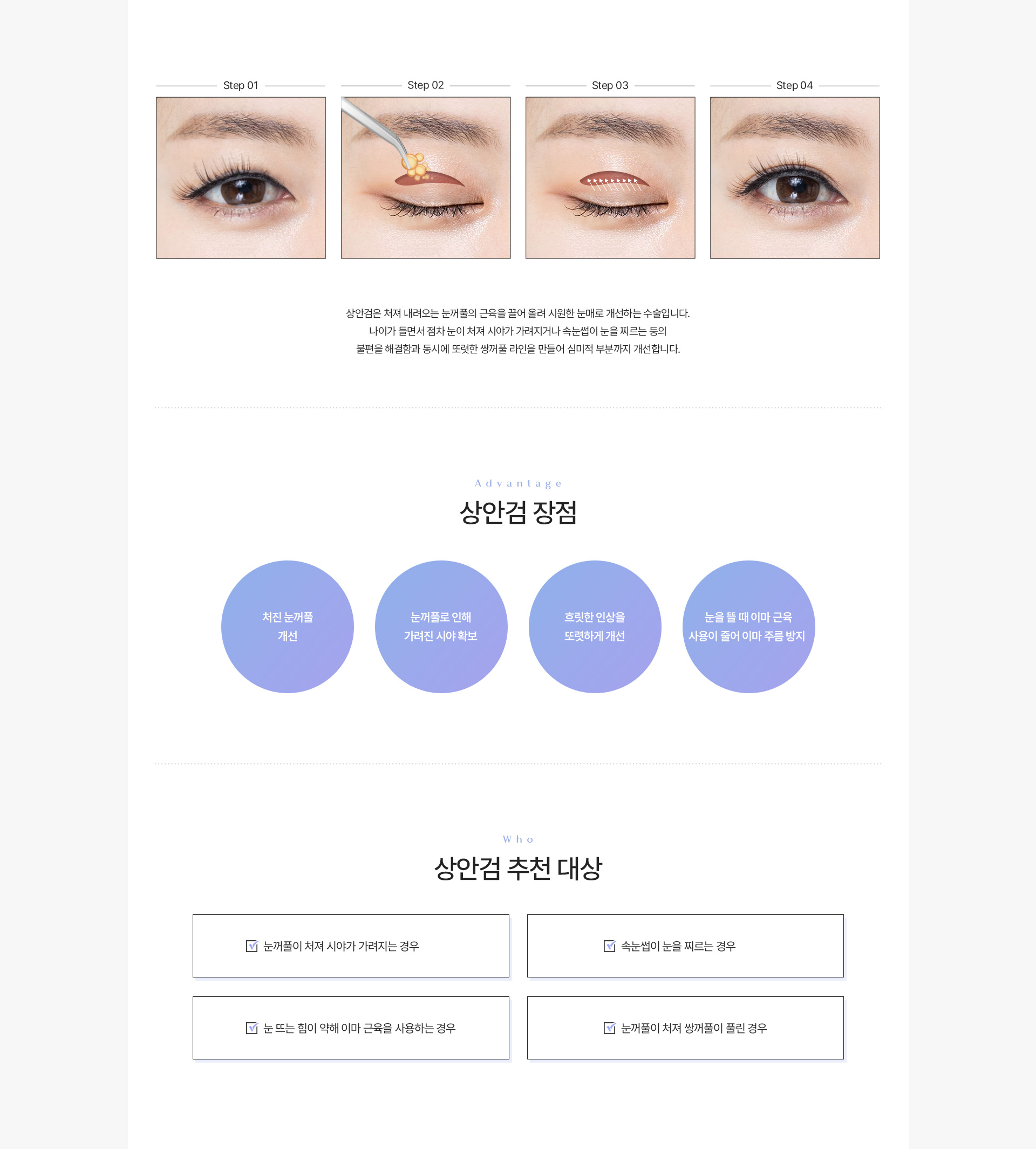 중년눈성형 상안검 내용