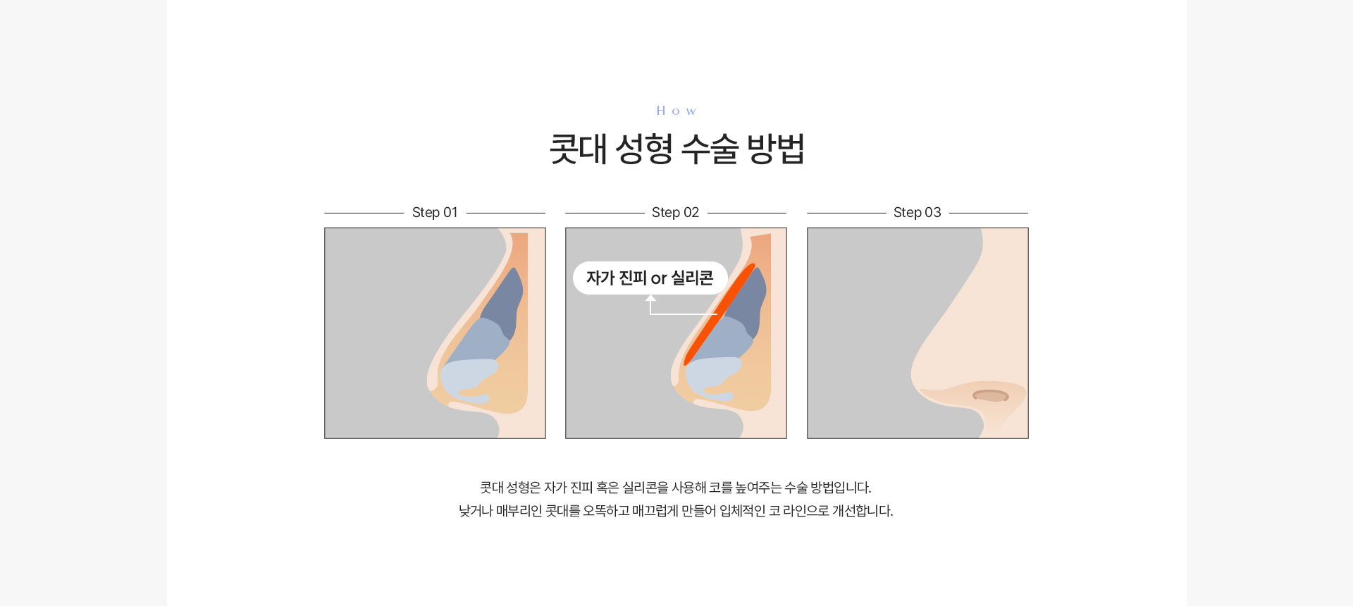콧대 수술방법