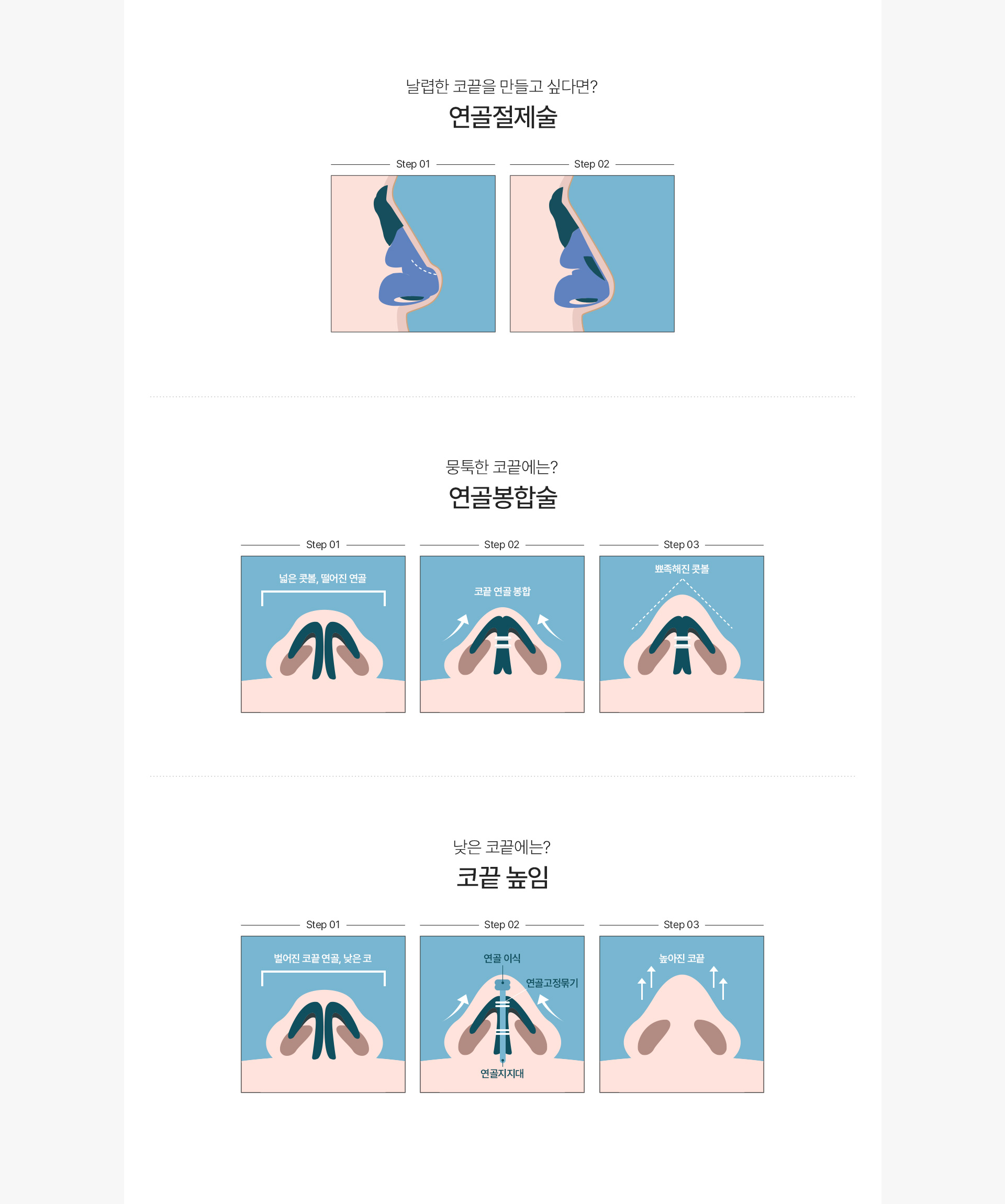 코끝 수술방법