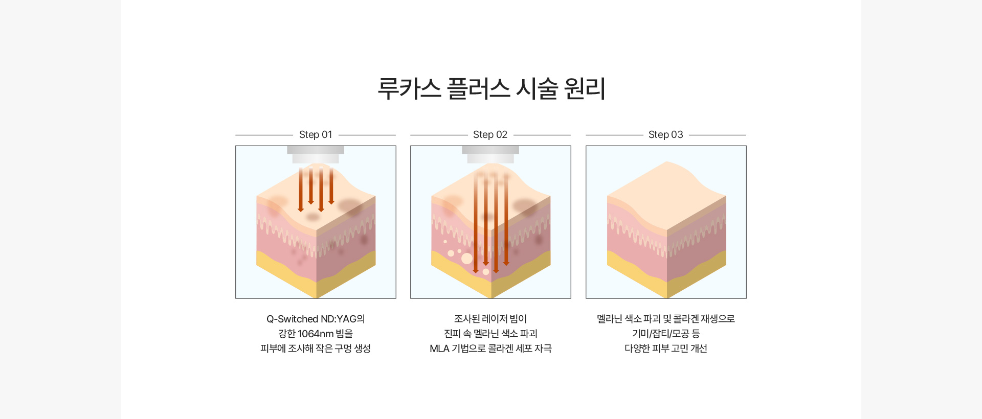 루카스플러스 시술원리