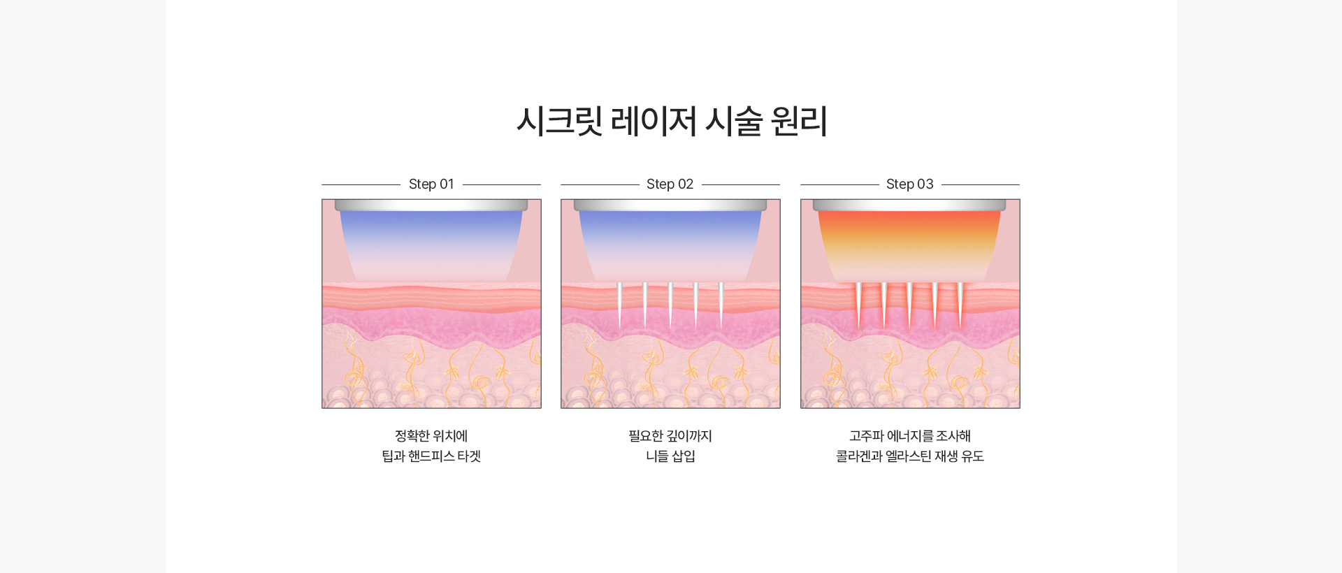 시크릿레이저 시술원리