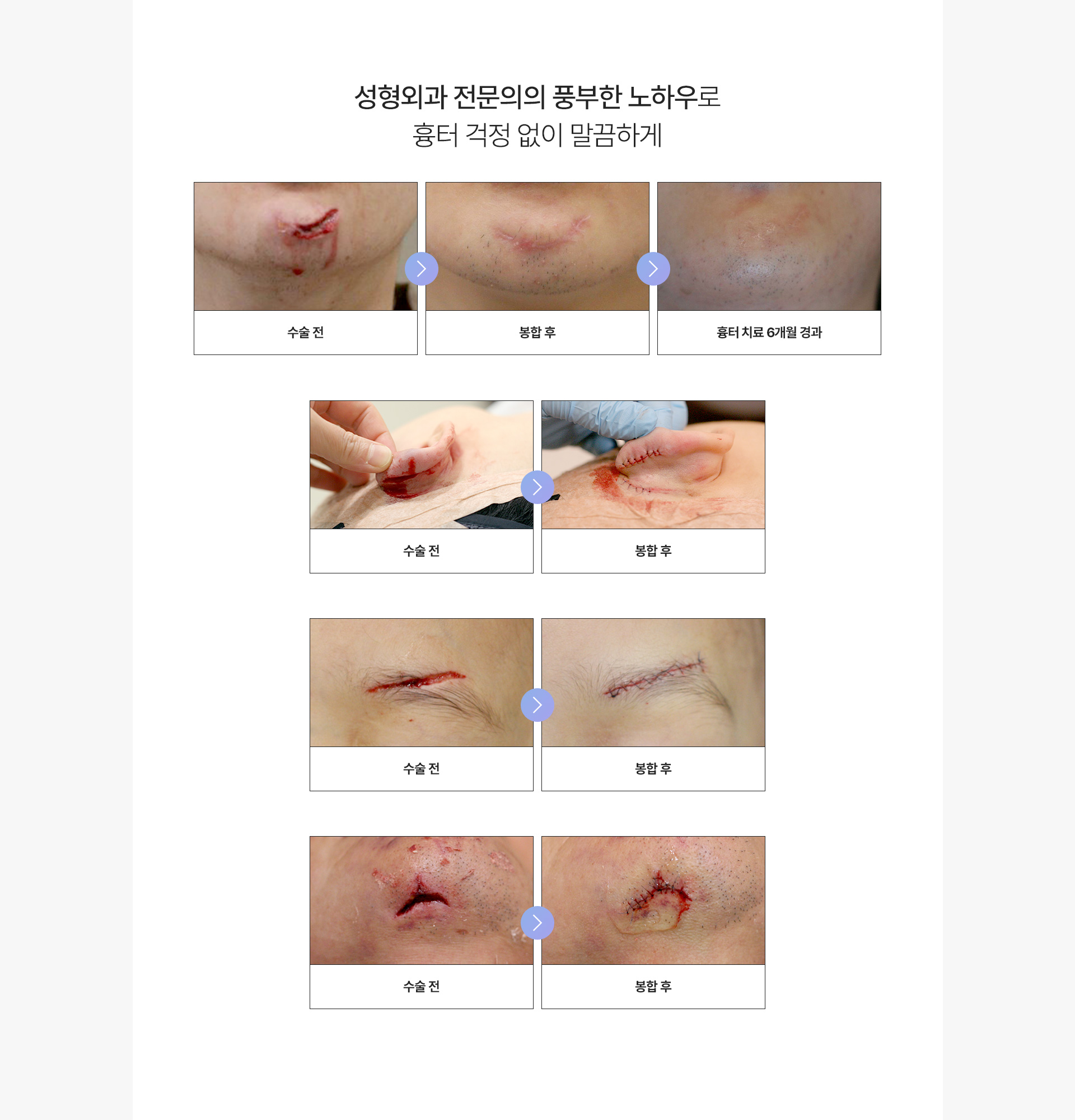 창상봉합 노하우
